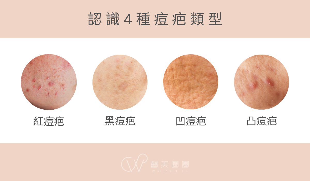 如何預防痘痘形成的護膚日常：完整教學與專業皮膚科護理師的獨家秘訣