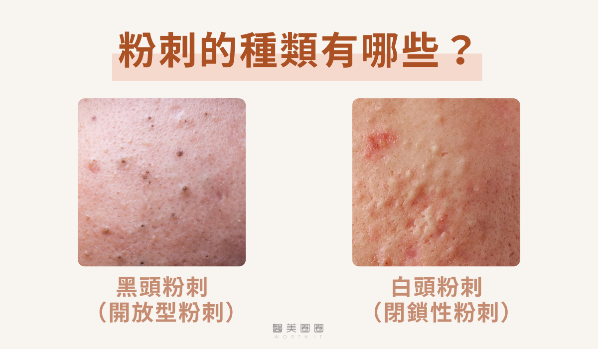粉刺是什麼?了解粉刺種類與原因,日常預防小妙招公開!