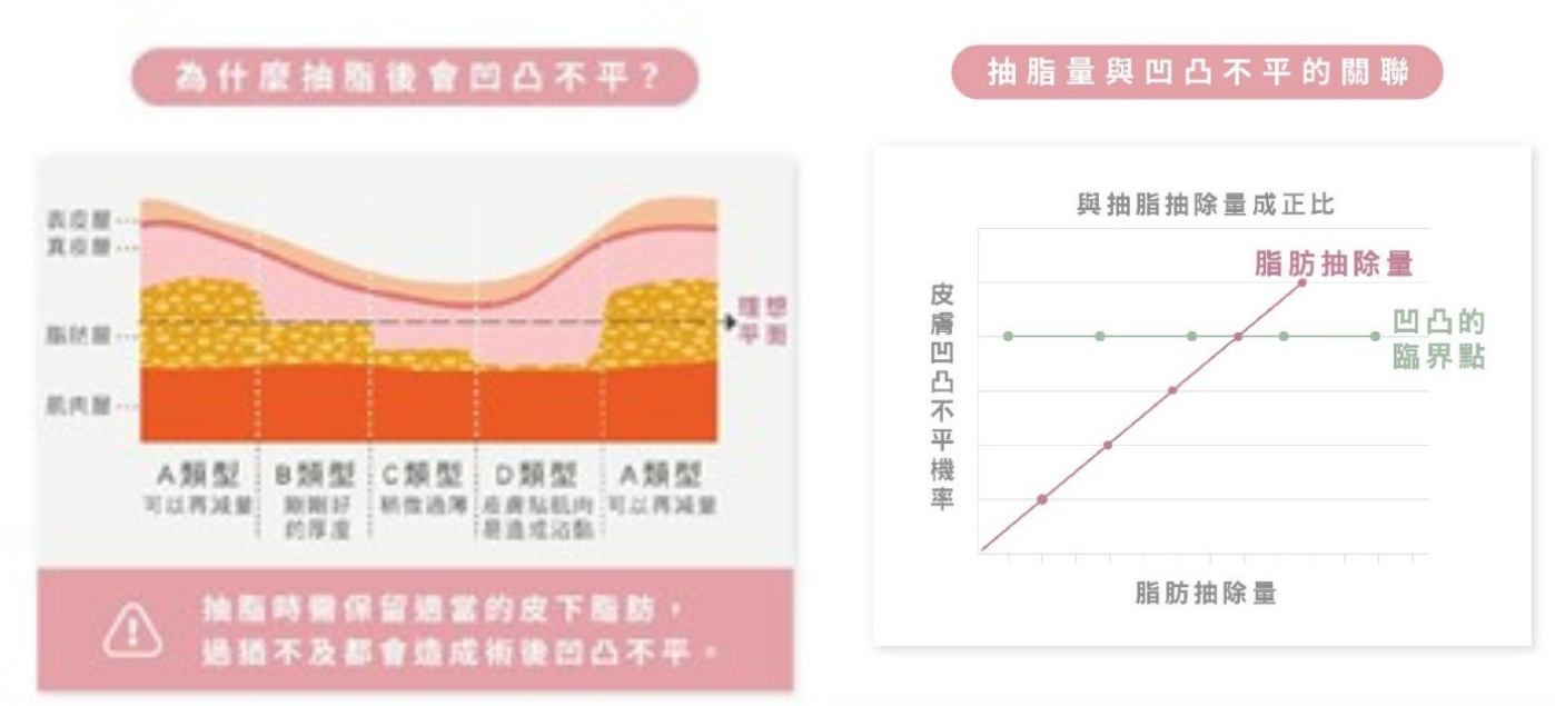 抽脂凹凸修復手術｜顯微套管抽脂